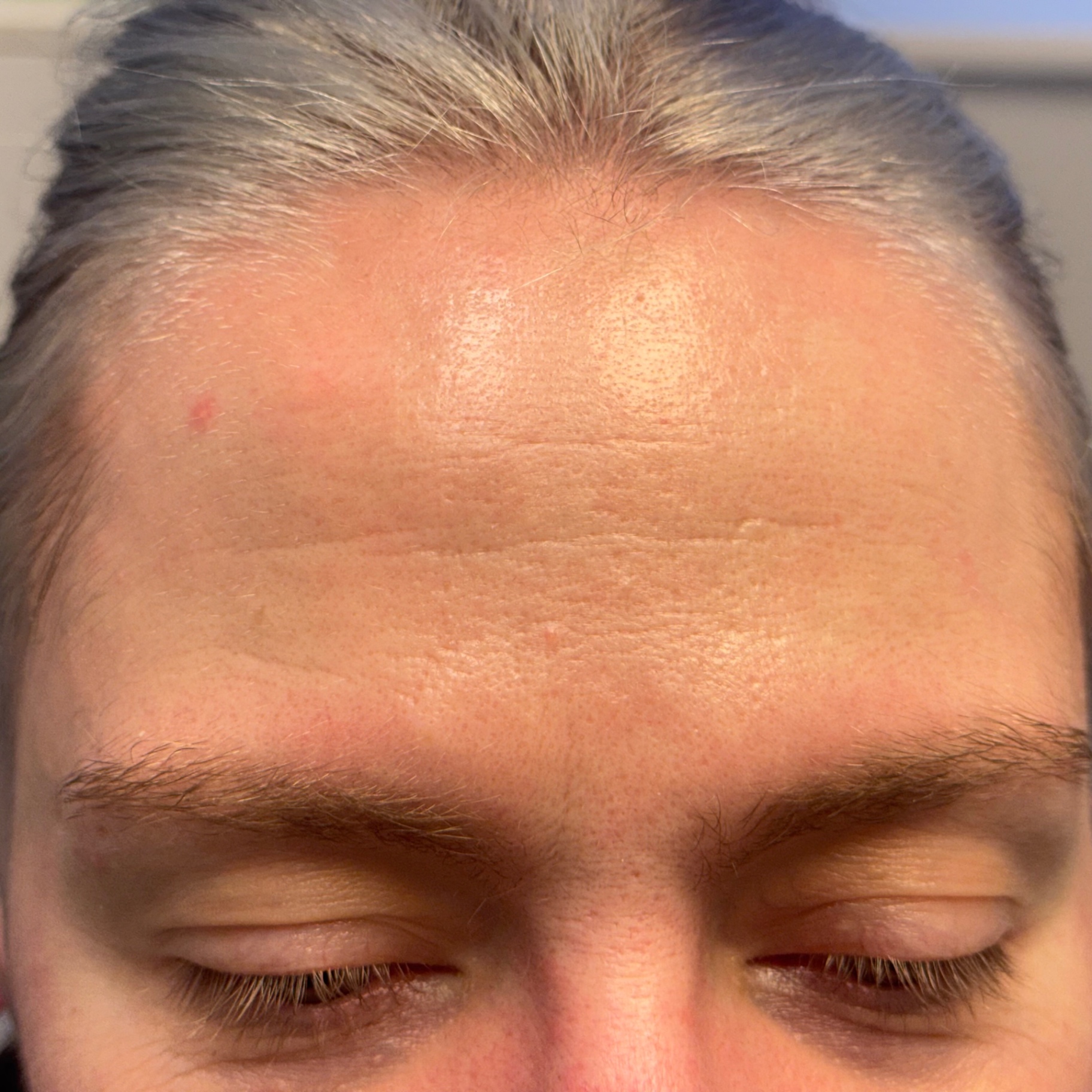 Panna efter botulinumtoxinbehandling